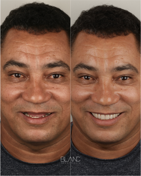 Antes e Depois - Reabilitação Oral